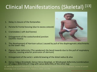 Clinical Manifestations (Skeletal) [13] 
1. Delay in closure of the fontanelles 
2. Parietal & frontal bossing (due to excess osteoid) 
3. Craniotabes ( soft skull bones) 
4. Enlargement of the costochondral junction 
(rachitic rosary) 
5. The development of Harrison sulcus ( caused by pull of the diaphragmatic attachments 
to the lower ribs) 
6. Pigeon chest deformity (The weakened ribs bend inwards due to the pull of respiratory 
muscles, causing anterior protrusion of sternum) 
7. Enlargement of the wrist + ankle & bowing of the distal radius & ulna 
8. Genus Valgus (knocked), Genus Verus (bowleg), or Windswept deformity (combination 
of valgus deformity of 1 leg with varus deformity of the other leg) 
13. Misra M, Pacaud D, Petryk A, et al. Vitamin D deficiency in children and its management: review of current 
knowledge and recommendations. Pediatrics 2008; 122:398. 
Pictures from http://www.thachers.org 
 