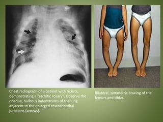 Chest radiograph of a patient with rickets, 
demonstrating a "rachitic rosary". Observe the 
opaque, bulbous indentations of the lung 
adjacent to the enlarged costochondral 
junctions (arrows). 
Bilateral, symmetric bowing of the 
femurs and tibias. 
 