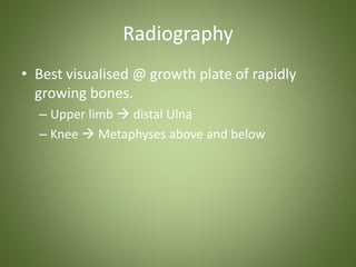 Radiography 
• Best visualised @ growth plate of rapidly 
growing bones. 
– Upper limb  distal Ulna 
– Knee  Metaphyses above and below 
 