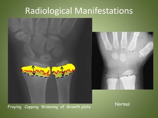 Radiological Manifestations 
Fraying Cupping Widening of Growth plate 
Normal 
 