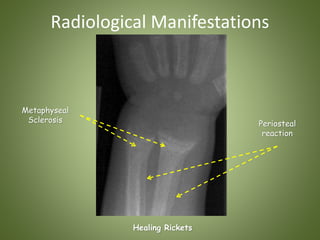 Radiological Manifestations 
Healing Rickets 
Periosteal 
reaction 
Metaphyseal 
Sclerosis 
 