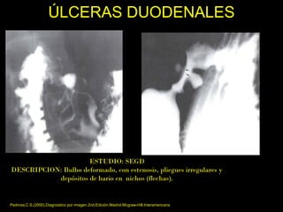 ÚLCERAS DUODENALESÚLCERAS DUODENALES
ESTUDIO: SEGD
DESCRIPCION: Bulbo deformado, con estenosis, pliegues irregulares y
depósitos de bario en nichos (flechas).
VISTA DE FRENTE VISTA DE PERFIL
Pedrosa.C.S,(2000).Diagnostico por imagen.2nd.Edición.Madrid.Mcgraw-Hill.Interamericana
 