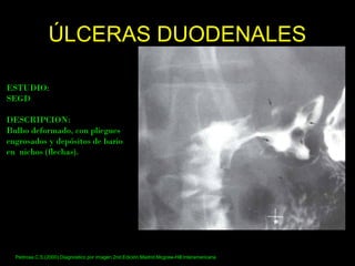 ÚLCERAS DUODENALESÚLCERAS DUODENALES
ESTUDIO:
SEGD
DESCRIPCION:
Bulbo deformado, con pliegues
engrosados y depósitos de bario
en nichos (flechas).
Pedrosa.C.S,(2000).Diagnostico por imagen.2nd.Edición.Madrid.Mcgraw-Hill.Interamericana
 