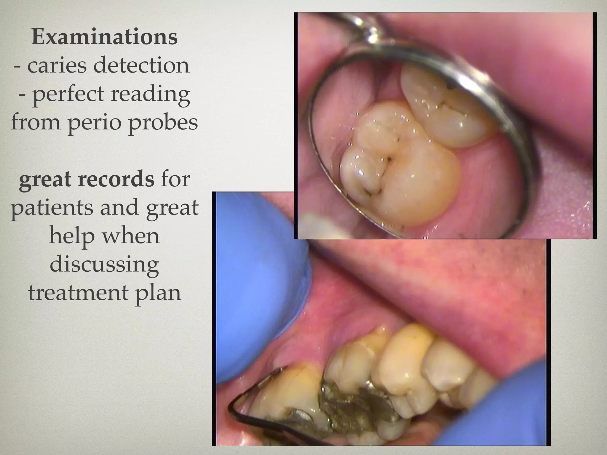 Examinations 
- caries detection 
- perfect reading 
from perio probes 
great records for 
patients and great 
help when 
discussing 
treatment plan 
 
