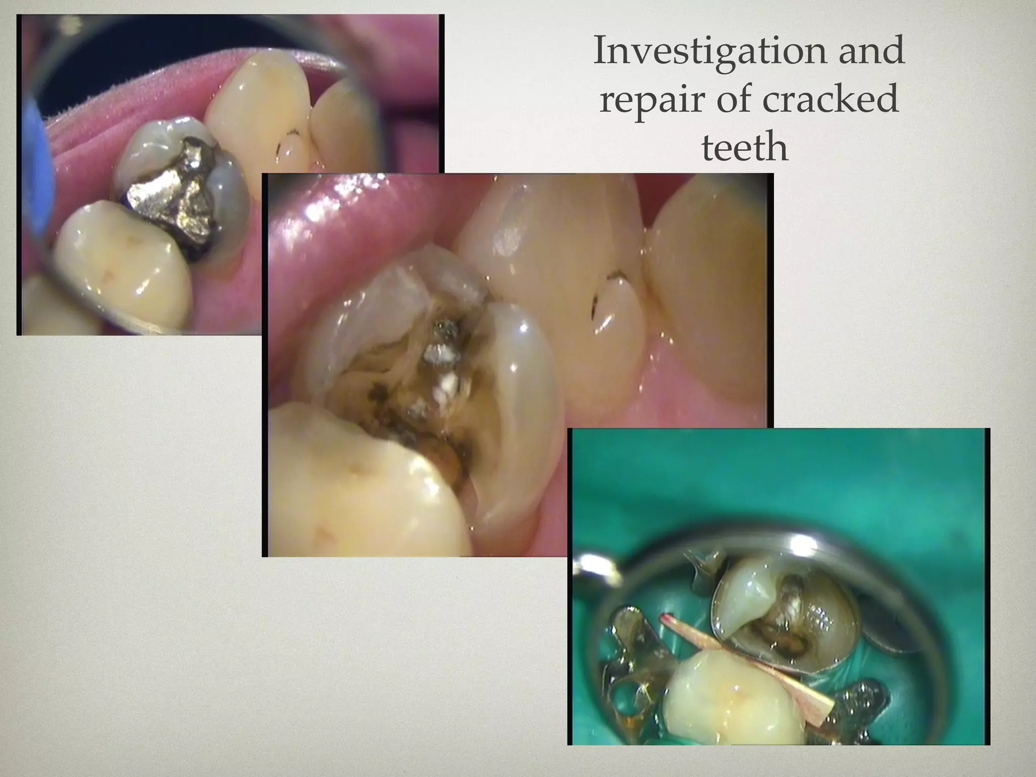 Investigation and 
repair of cracked 
teeth 
 