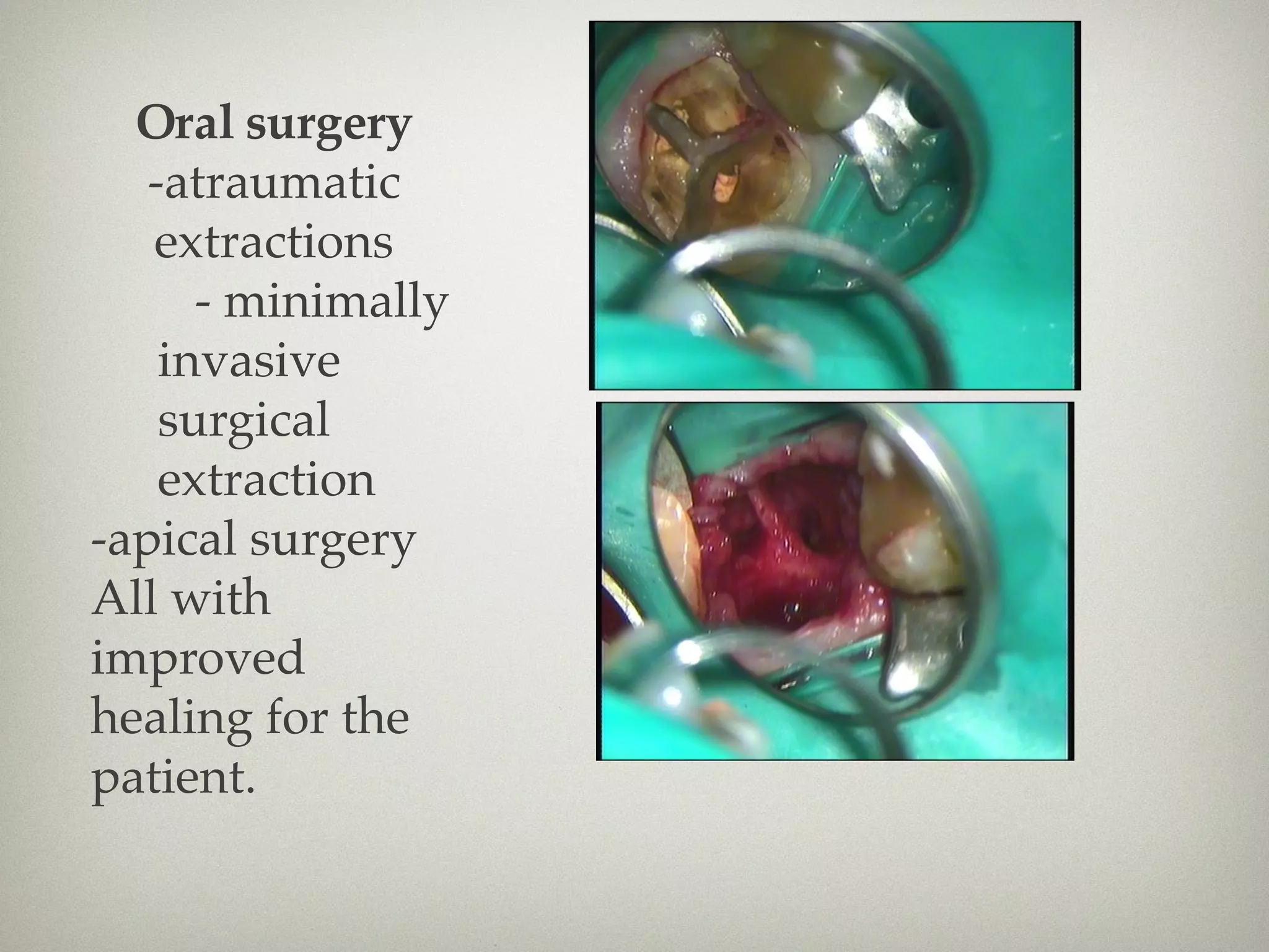 Oral surgery 
-atraumatic 
extractions 
- minimally 
invasive 
surgical 
extraction 
-apical surgery 
All with 
improved 
healing for the 
patient. 
 