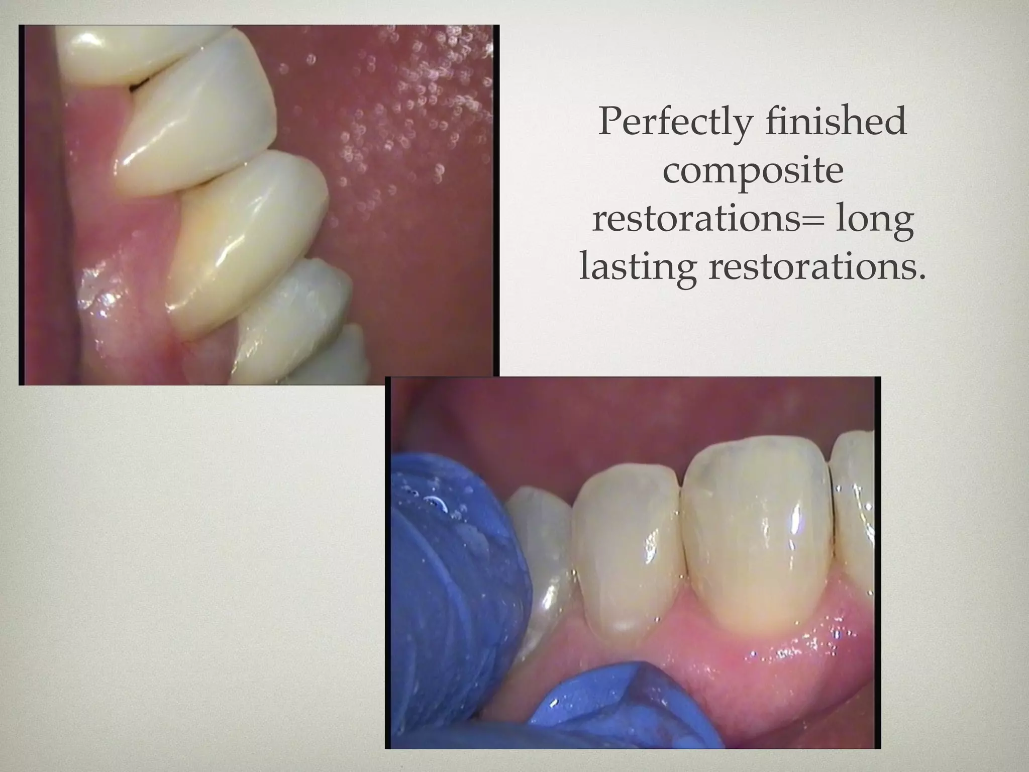 Perfectly finished 
composite 
restorations= long 
lasting restorations. 
 