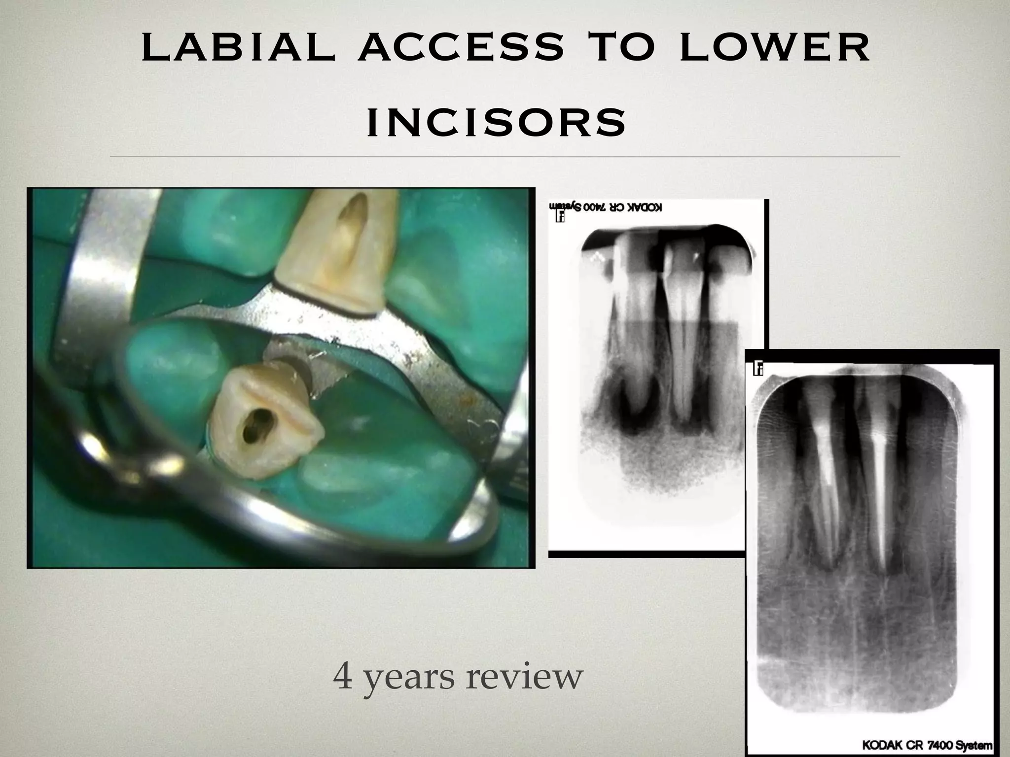 labial access to lower 
incisors 
4 years review 
 