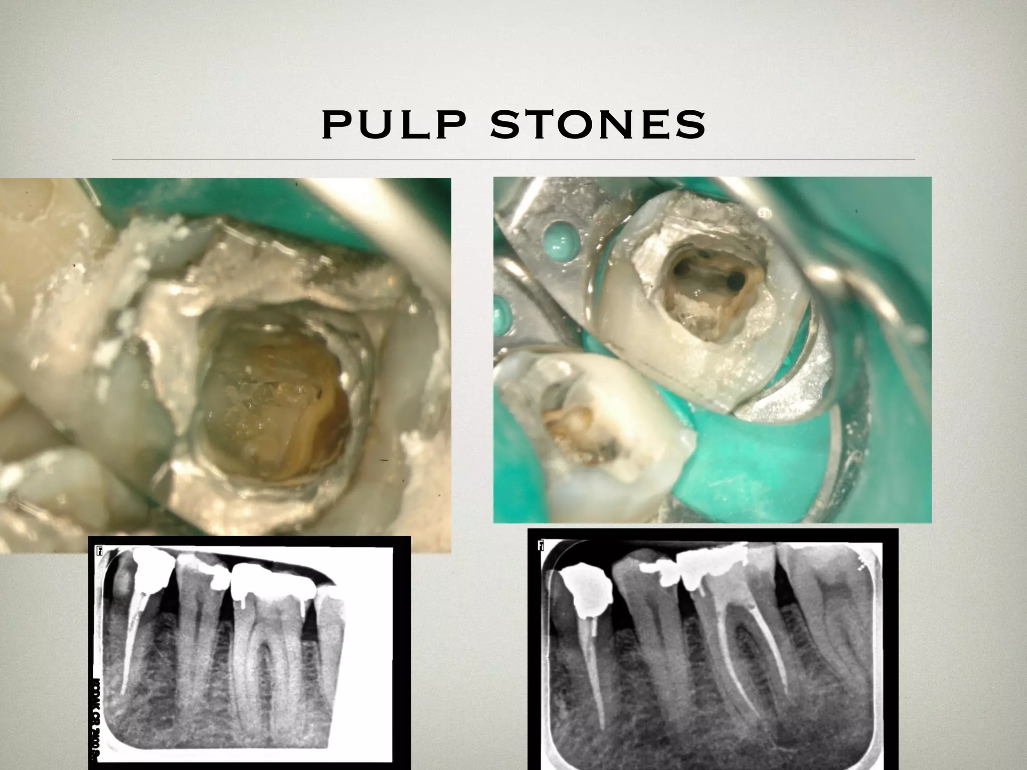 pulp stones 
 
