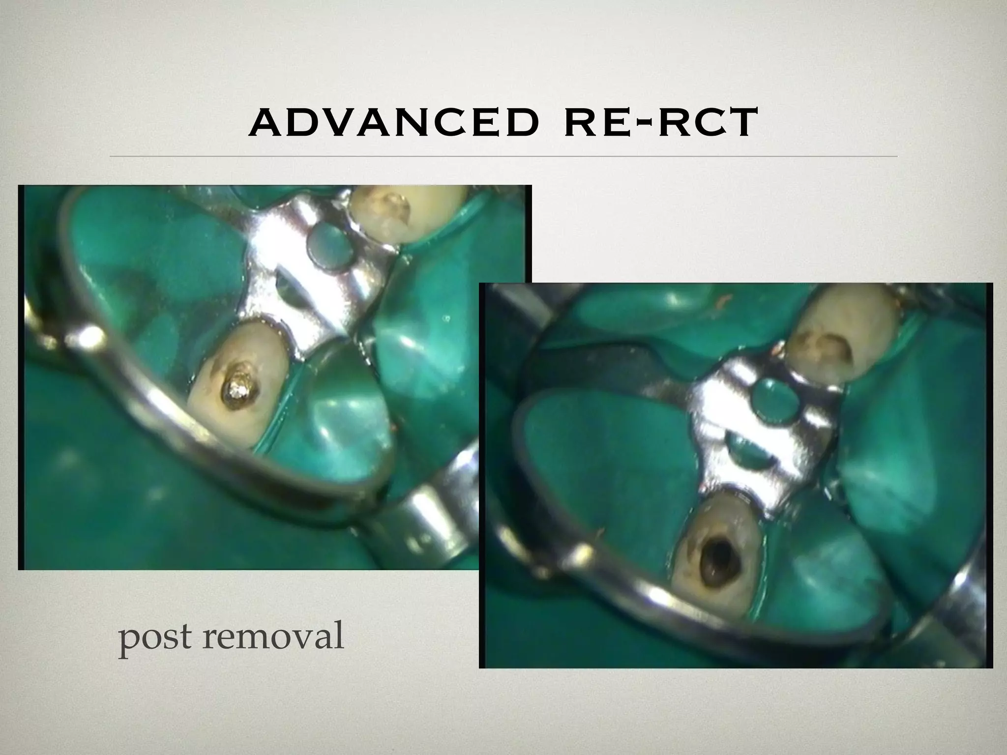 advanced re-rct 
post removal 
 