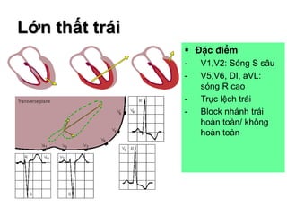 ECG TRONG LỚN NHĨ THẤT | PDF