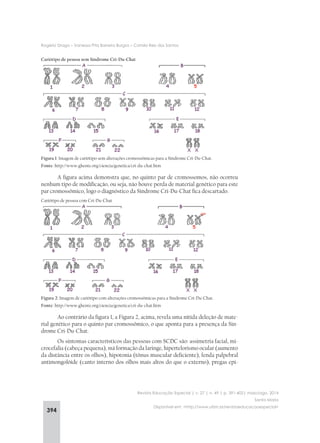 394
Rogério Drago – Vanessa Pita Barreira Burgos – Camila Reis dos Santos
Revista Educação Especial | v. 27 | n. 49 | p. 391-402| maio/ago. 2014
Santa Maria
Disponível em: <http://www.ufsm.br/revistaeducacaoespecial>
Cariótipo de pessoa sem Síndrome Cri-Du-Chat
Figura 1: Imagem de cariótipo sem alterações cromossômicas para a Síndrome Cri-Du-Chat.
Fonte: http://www.ghente.org/ciencia/genetica/cri-du-chat.htm
A figura acima demonstra que, no quinto par de cromossomos, não ocorreu
nenhum tipo de modificação, ou seja, não houve perda de material genético para este
par cromossômico, logo o diagnóstico da Síndrome Cri-Du-Chat fica descartado.
Cariótipo de pessoa com Cri-Du-Chat
Figura 2: Imagem de cariótipo com alterações cromossômicas para a Síndrome Cri-Du-Chat.
Fonte: http://www.ghente.org/ciencia/genetica/cri-du-chat.htm
Ao contrário da figura 1, a Figura 2, acima, revela uma nítida deleção de mate-
rial genético para o quinto par cromossômico, o que aponta para a presença da Sín-
drome Cri-Du-Chat.
Os sintomas característicos das pessoas com SCDC são: assimetria facial, mi-
crocefalia (cabeça pequena), má formação da laringe, hipertelorismo ocular (aumento
da distância entre os olhos), hipotonia (tônus muscular deficiente), fenda palpebral
antimongolóide (canto interno dos olhos mais altos do que o externo), pregas epi-
 