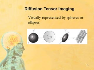 Diffusion Tensor Imaging
13
Visually represented by spheres or
ellipses
 