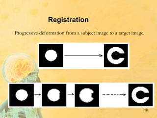 Registration
Progressive deformation from a subject image to a target image.
19
u
 