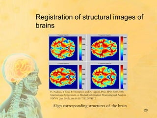 20
Registration of structural images of
brains
Align corresponding structures of the brain
H. Nadeau, Y Chai, P. Thompson and N. Leporé, Proc. SPIE 9287, 10th
International Symposium on Medical Information Processing and Analysis
92870V (Jan. 2015); doi:10.1117/12.2074112.
 