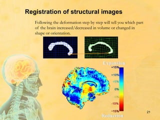 21
Registration of structural images
Following the deformation step by step will tell you which part
of the brain increased/decreased in volume or changed in
shape or orientation.
 
