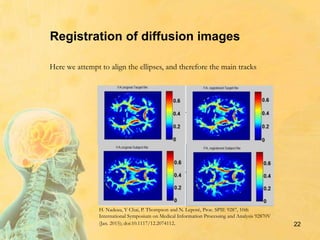 22
Registration of diffusion images
Here we attempt to align the ellipses, and therefore the main tracks
H. Nadeau, Y Chai, P. Thompson and N. Leporé, Proc. SPIE 9287, 10th
International Symposium on Medical Information Processing and Analysis 92870V
(Jan. 2015); doi:10.1117/12.2074112.
 