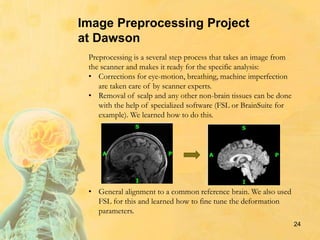 24
Preprocessing is a several step process that takes an image from
the scanner and makes it ready for the specific analysis:
• Corrections for eye-motion, breathing, machine imperfection
are taken care of by scanner experts.
• Removal of scalp and any other non-brain tissues can be done
with the help of specialized software (FSL or BrainSuite for
example). We learned how to do this.
• General alignment to a common reference brain. We also used
FSL for this and learned how to fine tune the deformation
parameters.
Image Preprocessing Project
at Dawson
 
