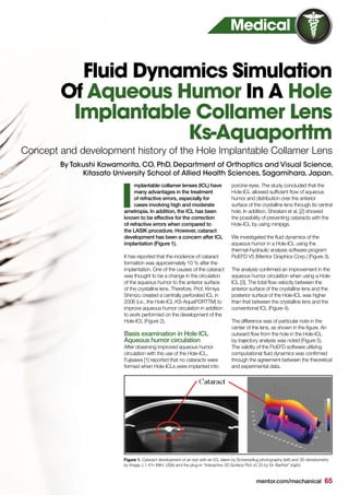mentor.com/mechanical 65
mplantable collamer lenses (ICL) have
many advantages in the treatment
of refractive errors, especially for
cases involving high and moderate
ametropia. In addition, the ICL has been
known to be effective for the correction
of refractive errors when compared to
the LASIK procedure. However, cataract
development has been a concern after ICL
implantation (Figure 1).
It has reported that the incidence of cataract
formation was approximately 10 % after the
implantation. One of the causes of the cataract
was thought to be a change in the circulation
of the aqueous humor to the anterior surface
of the crystalline lens. Therefore, Prof. Kimiya
Shimizu created a centrally perforated ICL in
2006 (i.e., the Hole-ICL KS-AquaPORTTM) to
improve aqueous humor circulation in addition
to work performed on the development of the
Hole-ICL (Figure 2).
Basis examination in Hole ICL
Aqueous humor circulation
After observing improved aqueous humor
circulation with the use of the Hole-ICL,
Fujisawa [1] reported that no cataracts were
formed when Hole-ICLs were implanted into
porcine eyes. The study concluded that the
Hole-ICL allowed sufficient flow of aqueous
humor and distribution over the anterior
surface of the crystalline lens through its central
hole. In addition, Shiratani et al. [2] showed
the possibility of preventing cataracts with the
Hole-ICL by using minipigs.
We investigated the fluid dynamics of the
aqueous humor in a Hole-ICL using the
thermal–hydraulic analysis software program
FloEFD V5 (Mentor Graphics Corp.) (Figure 3).
The analysis confirmed an improvement in the
aqueous humor circulation when using a Hole-
ICL [3]. The total flow velocity between the
anterior surface of the crystalline lens and the
posterior surface of the Hole-ICL was higher
than that between the crystalline lens and the
conventional ICL (Figure 4).
The difference was of particular note in the
center of the lens, as shown in the figure. An
outward flow from the hole in the Hole-ICL
by trajectory analysis was noted (Figure 5).
The validity of the FloEFD software utilizing
computational fluid dynamics was confirmed
through the agreement between the theoretical
and experimental data.
I
Fluid Dynamics Simulation
Of Aqueous Humor In A Hole
Implantable Collamer Lens
Ks-Aquaporttm
By Takushi Kawamorita, CO, PhD, Department of Orthoptics and Visual Science,
Kitasato University School of Allied Health Sciences, Sagamihara, Japan.
Medical
Concept and development history of the Hole Implantable Collamer Lens
Figure 1. Cataract development of an eye with an ICL taken by Scheimpflug photography (left) and 3D densitometry
by Image J 1.47v (NIH, USA) and the plug-in “Interactive 3D Surface Plot v2.33 by Dr. Barthel” (right)
 