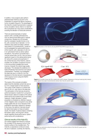 66 mentor.com/mechanical
In addition, many surgeons also perform
peripheral laser iridotomy (LI) prior to ICL
implantation to prevent the failure of aqueous
humor circulation (Figure 6). The advantages of
the Hole-ICL include improvements in aqueous
humor circulation; hence, there is no need for
the LI procedure as it may cause complications
including the elevation of intraocular pressure.
There are several examples of optical
systems with a centrally perforated lens,
such as astronomical telescopes or special
contact lens. Shiratani et al. [2] showed
that the modulation transfer function of an
ICL with a central hole of diameter 1.0 mm
obtained using optical simulation software
was similar to a conventional ICL. Uozato et
al. [4] investigated the optical performance
of the Hole-ICL with a diameter of 0.36 mm
in an optical bench test as well as optical
simulations. The authors concluded that a
minimal central hole in an ICL may not have a
significant impact on the optical performance
for various ICL powers and pupil sizes. If
the central hole size of the Hole-ICL were to
increase, the circulation of aqueous humour
in the surrounding crystalline lens would
improve. However, the retinal image quality
decreases. This indicates the existence of a
trade-off between fluid dynamics and optical
characteristics. Therefore, we investigated
the ideal hole size in a Hole-ICL from the
standpoint of the fluid dynamic characteristics
of the aqueous humor using the FloEFD
software (Figure 7) .
The results of the computer simulation
determined the desirable central hole size as
0.2 mm or larger based on fluid dynamics.
The current model, based on a central hole
size of 0.36 mm, was close to the ideal size.
The optimization of the hole size should be
performed based on results from a long-term
clinical study to allow for analysis of the optical
performance and incidence rate of secondary
cataracts. A slight decrease in optical
properties is considered an effective measure
of risk mitigation when compared to low retinal
image quality that can occur because of the
potential for secondary cataracts to develop.
In the future, the optimum hole size should
be determined based on these simulation
results, the results of optical analysis containing
illumination optics, and long-term clinical
results regarding visual performance, optical
performance and complications.
Clinical results of the Hole ICL
Our results suggest that Hole-ICLs improve
the circulation of the aqueous humor to the
anterior surface of the crystalline lens. The
Hole-ICL is expected to continue to lower
the risk of cataracts. Currently, the Hole-ICL
Figure 2. Illustration of the Hole-ICL KS-AquaPORTTM (STARR Surgical CO Ltd.)
Figure 3. 3D models of eyes with ICLs created with FloEFD software. Appearance of the eye model (top left), Anterior
ocular segment (top right), Conventional ICL (bottom left), Hole-ICL (bottom right)
Figure 4. Flow distribution along the long axis of the cross-sectional surface of the Hole-ICL (upper) and the
conventional ICL (lower)
 