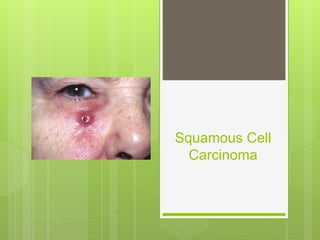 Squamous Cell
Carcinoma
 