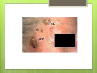 86467621 squamous-cell-carcinoma