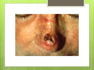 86467621 squamous-cell-carcinoma