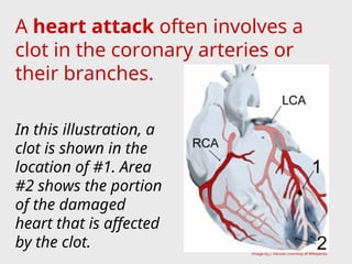 A heart attack often involves a
clot in the coronary arteries or
their branches.
In this illustration, a
clot is shown in the
location of #1. Area
#2 shows the portion
of the damaged
heart that is affected
by the clot. Image by J. Heuser courtesy of Wikipedia.
 