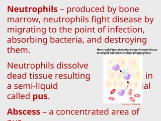Neutrophils – produced by bone
marrow, neutrophils fight disease by
migrating to the point of infection,
absorbing bacteria, and destroying
them.
Neutrophils dissolve
dead tissue resulting in
a semi-liquid material
called pus.
Abscess – a concentrated area of
Neutrophil (purple) migrating through tissue
to engulf bacteria through phagocytosis.
Courtesy of Wikipedia.
 