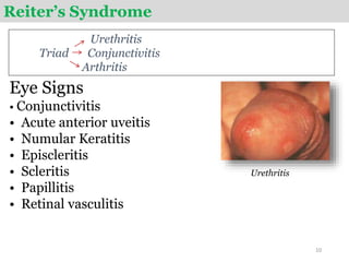 Reiter’s Syndrome
Urethritis
Triad Conjunctivitis
Arthritis
Eye Signs
• Conjunctivitis
• Acute anterior uveitis
• Numular Keratitis
• Episcleritis
• Scleritis
• Papillitis
• Retinal vasculitis
10
Urethritis
 