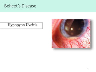 11
Hypopyon Uveitis
Behcet’s Disease
 