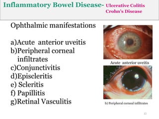 Inflammatory Bowel Disease- Ulcerative Colitis
Crohn’s Disease
Ophthalmic manifestations
a)Acute anterior uveitis
b)Peripheral corneal
infiltrates
c)Conjunctivitis
d)Episcleritis
e) Scleritis
f) Papillitis
g)Retinal Vasculitis
12
b) Peripheral corneal infiltrates
Acute anterior uveitis
 