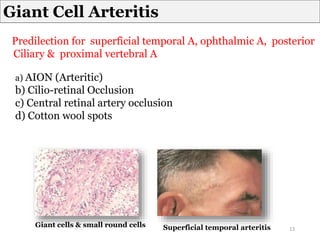 Predilection for superficial temporal A, ophthalmic A, posterior
Ciliary & proximal vertebral A
a) AION (Arteritic)
b) Cilio-retinal Occlusion
c) Central retinal artery occlusion
d) Cotton wool spots
Giant Cell Arteritis
Giant cells & small round cells Superficial temporal arteritis 13
 