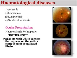 Haematological diseases
1) Anaemia
2) Leukaemia
3) Lymphomas
4) Sickle cell Anaemia
Ocular Presentation:
Haemorrhagic Retinopathy
“ROTHS SPOT”
red spots with white centers
that appear on the retina
composed of coagulated
fibrin
16
 