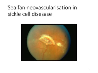 Sea fan neovascularisation in
sickle cell disesase
17
 