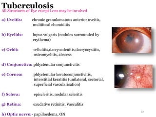 Tuberculosis
All Structures of Eye except Lens may be involved
a) Uveitis: chronic granulomatous anterior uveitis,
multifocal choroiditis
b) Eyelids: lupus vulgaris (nodules surrounded by
erythema)
c) Orbit: cellulitis,dacryoadenitis,dacryocystitis,
osteomyelitis, abscess
d) Conjunctiva: phlyctenular conjunctivitis
e) Cornea: phlyctenular keratoconjunctivitis,
interstitial keratitis (unilateral, sectorial,
superficial vascularisation)
f) Sclera: episcleritis, nodular scleritis
g) Retina: exudative retinitis, Vasculitis
h) Optic nerve:- papilloedema, ON
19
 