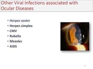 Other Viral Infections associated with
Ocular Diseases
• Herpes zoster
• Herpes simplex
• CMV
• Rubella
• Measles
• AIDS
21
 