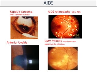 AIDS
Kaposi’s sarcoma-
most common tumour
AIDS retinopathy- 50 to 70%
CMV retinitis- most common
opportunistic infection
Anterior Uveitis
 