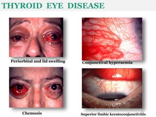 Periorbital and lid swelling Conjunctival hyperaemia
Chemosis Superior limbic keratoconjunctivitis
THYROID EYE DISEASE
27
 