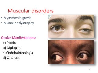 Muscular disorders
• Myasthenia gravis
• Muscular dystrophy
Ocular Manifestations:
a) Ptosis
b) Diplopia,
c) Ophthalmoplegia
d) Cataract
30
 
