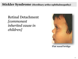 Stickler Syndrome (Herditary artho-ophthalmopathy)
Retinal Detachment
[commonest
inherited cause in
children]
Flat nasal bridge
33
 