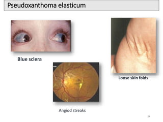 34
Pseudoxanthoma elasticum
Blue sclera
Loose skin folds
Angiod streaks
 
