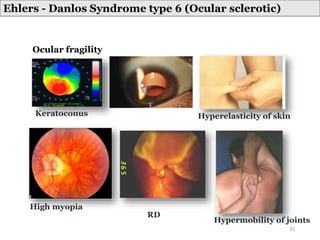 Ehlers - Danlos Syndrome type 6 (Ocular sclerotic)
Ocular fragility
Hyperelasticity of skin
Hypermobility of joints
High myopia
RD
Keratoconus
35
 