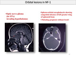 •Optic nerve glioma
(in 15%)
invading hypothalamus
•Spheno-orbital encephalocele showing
congenital absence of left greater wing
of sphenoid bone
• Pulsating proptosis without bruit!
Orbital lesions in NF-1
37
 