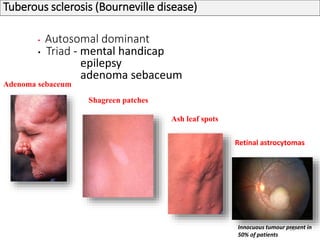 Tuberous sclerosis (Bourneville disease)
• Autosomal dominant
• Triad - mental handicap
epilepsy
adenoma sebaceum
Adenoma sebaceum
Ash leaf spots
Shagreen patches
39
Retinal astrocytomas
Innocuous tumour present in
50% of patients
 