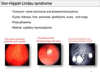 Von-Hippel-Lindau syndrome
•Tumours– renal carcinoma and phaeochromocytoma
•Cysts- kidneys, liver, pancreas, epididymis, ovary and lungs
•Polycythaemia
•Retinal capillary haemangioma
Tiny lesion between
arteriole and venuole
Choridal growth-
Round orange-red mass
Associated dilatation and
tortuosity of feeder vessels
40
 