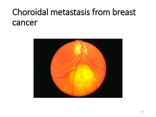 Choroidal metastasis from breast
cancer
43
 