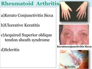 Rheumatoid Arthritis
a)Kerato Conjunctivitis Sicca
b)Ulcerative Keratitis
c)Acquired Superior oblique
tendon sheath syndrome
d)Scleritis
6
Scleritis
Keratoconjunctivitis Sicca
 