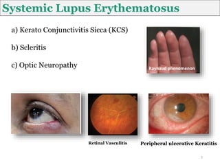 a) Kerato Conjunctivitis Sicca (KCS)
b) Scleritis
c) Optic Neuropathy
Systemic Lupus Erythematosus
Raynaud phenomenon
7
Peripheral ulcerative Keratitis
Retinal Vasculitis
 