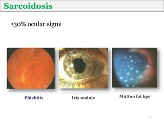 Sarcoidosis
Mutton fat kps
Iris nodule
Phlebitis
8
•30% ocular signs
 
